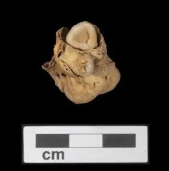 У стародавньої єгиптянки, яка померла понад 3000 років тому, знайшли пухлину із зубами – фото