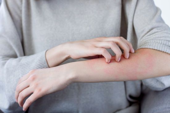 Що таке алергія на холод: як проявляється і чим лікувати