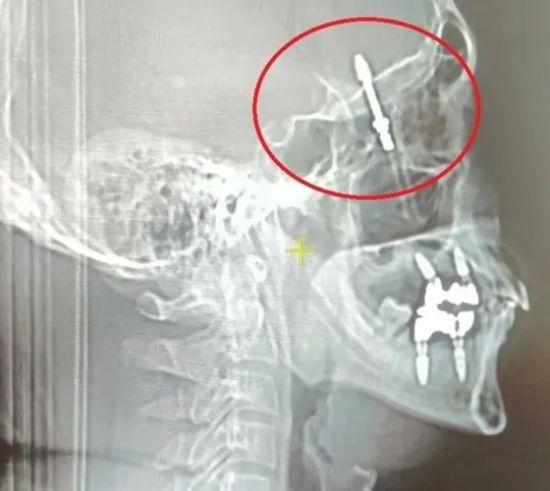 Не розрахував сили: стоматолог загвинтив імплантат у череп пацієнта (фото)