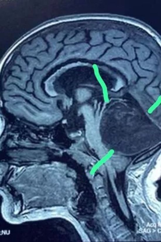 Хірурги помітили дивне утворення у мозку 8-річної дівчинки: те, що це було насправді, нажахало їх