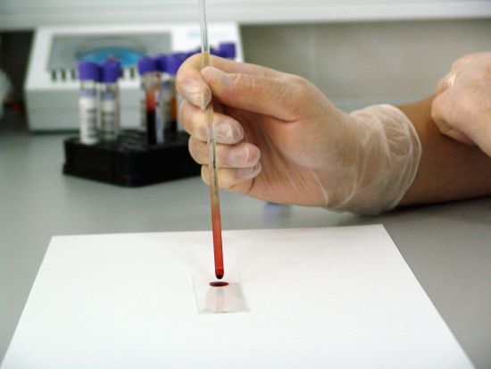 Медики заявили про “нову еру” в лікуванні раку крові – дослідження